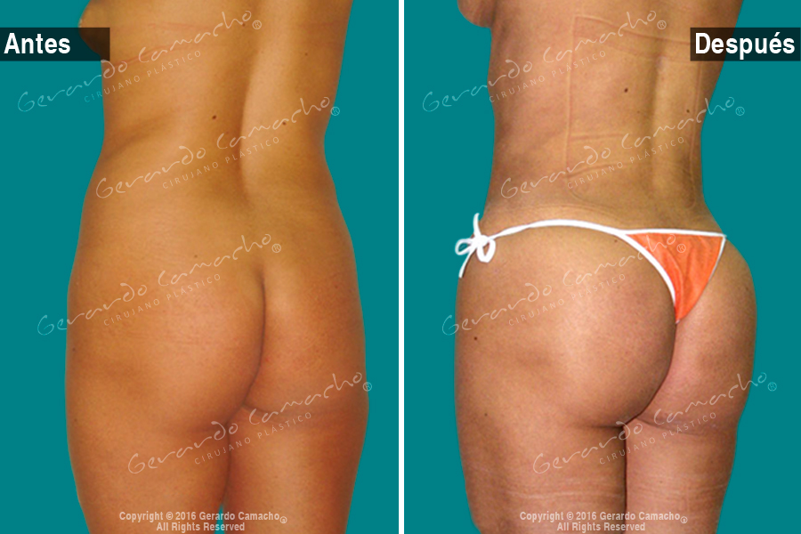 Figura remodelada con gluteoplastia en Bogotá